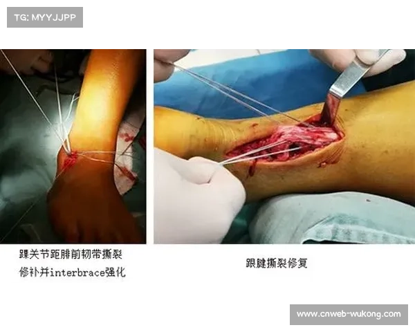 羽毛球运动损伤研究中心成立，将重点关注跟腱与膝关节